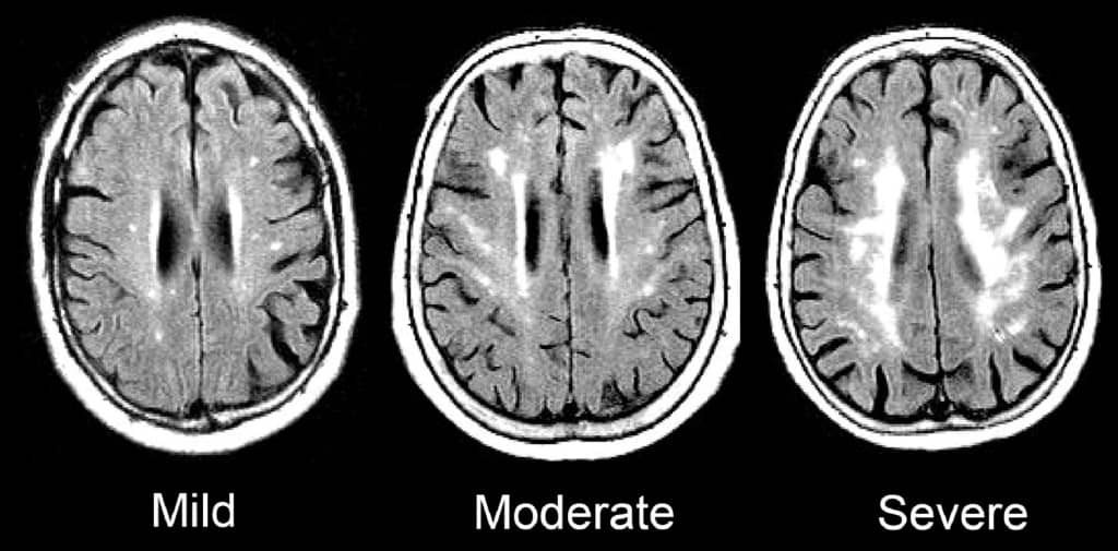 MRI brain cerebral small vessel ischemic disease