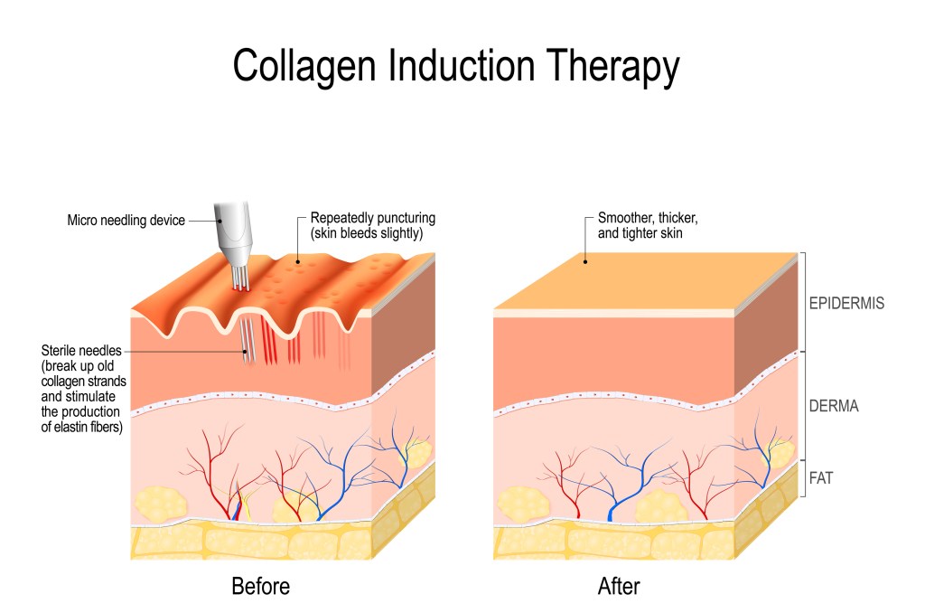 Microneedling is The Number One Hollywood Anti-Aging Treatment