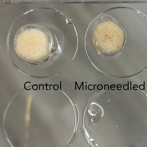 Microneedling decayed, thinned and discolored the...