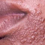 Perioral Dermatitis: Causes, Triggers + Effective...