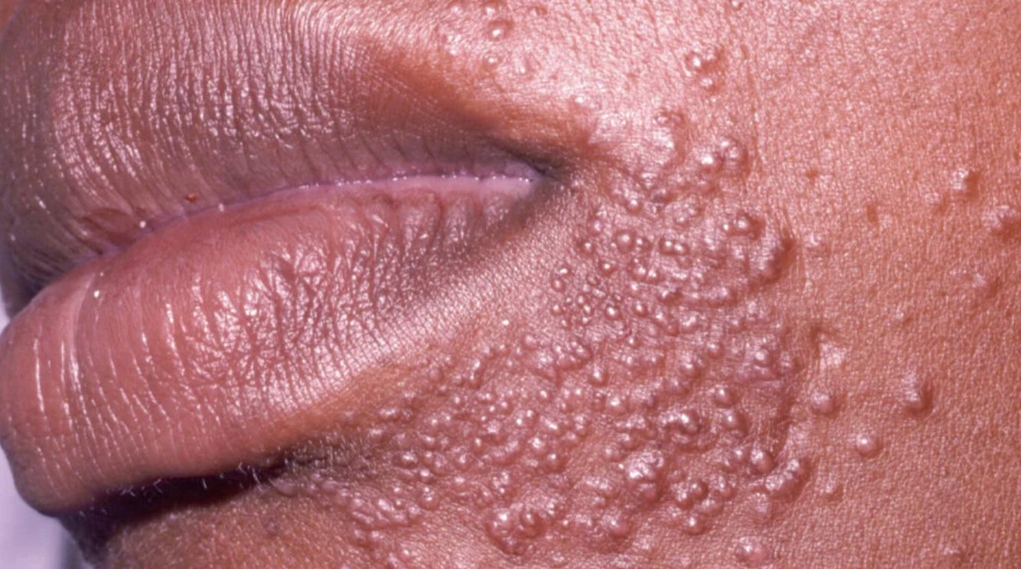 Perioral Dermatitis: Causes, Triggers + Effective...