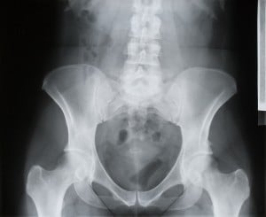 How to Avoid a Missed Pelvic...