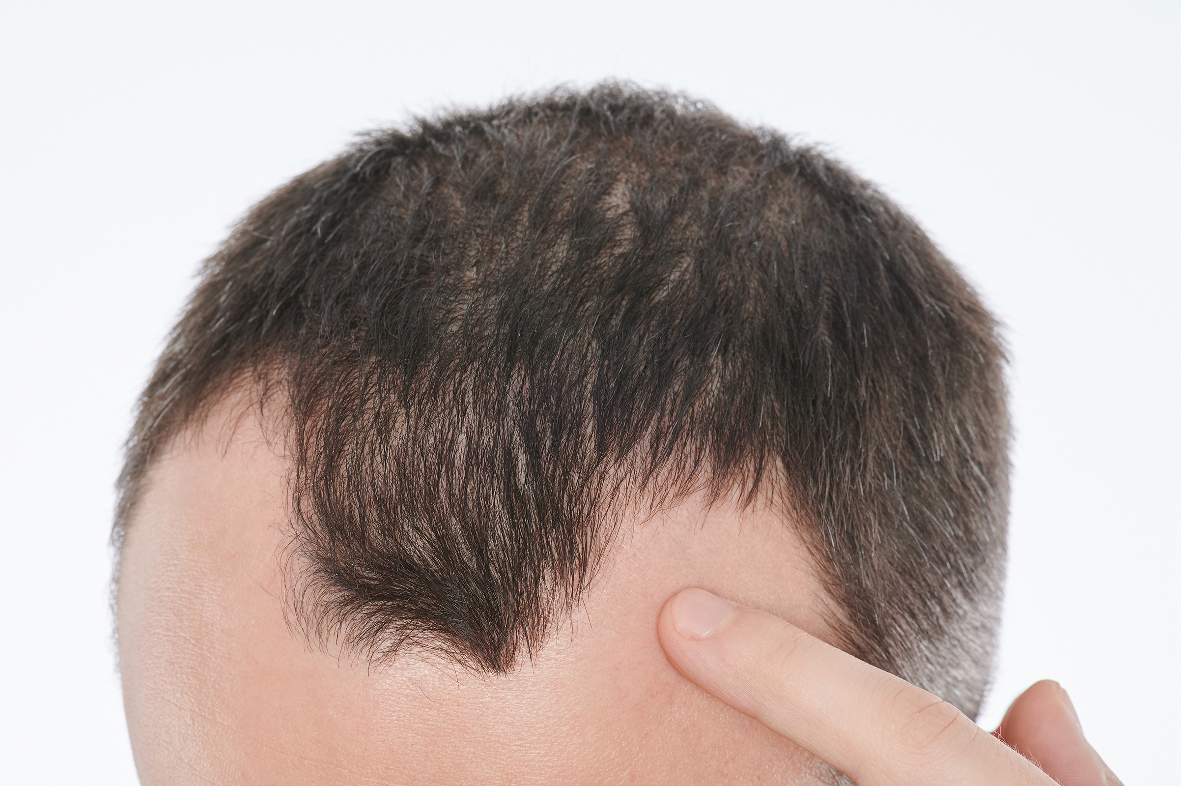 Could nutrient deficiencies lead to hair...