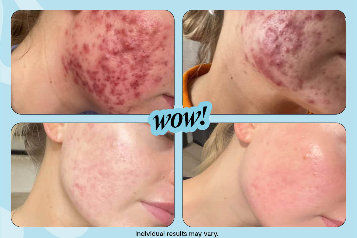 An amazing real-life acne story (with...